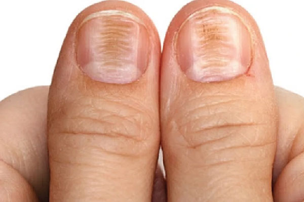 Healthy, well-groomed nails after professional nail care treatment