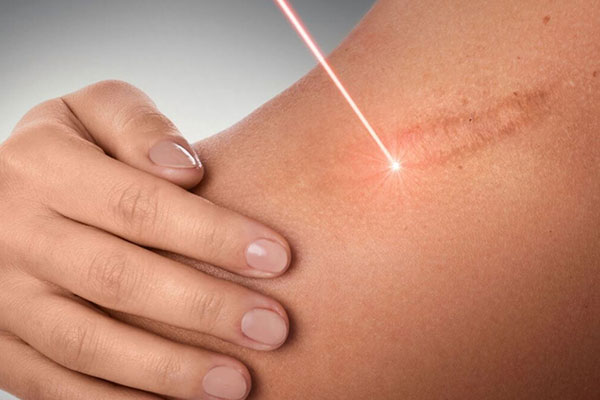 Repairing serum being applied to skin to improve scars and stretch marks
