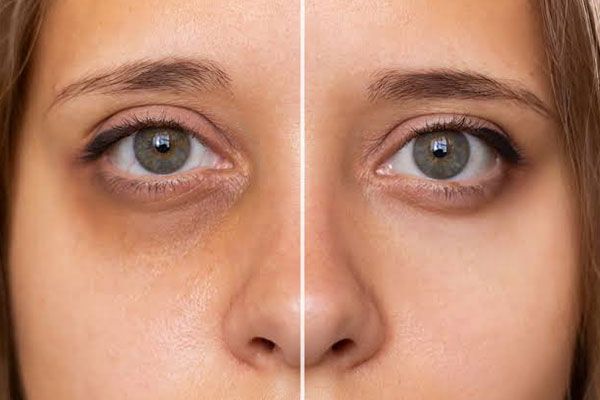 Close-up of the delicate eye area during a professional beauty treatment