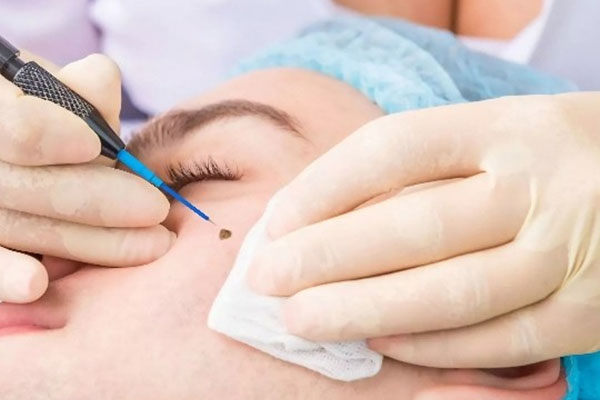 Clean procedure bed prepared for a comfortable mole removal session